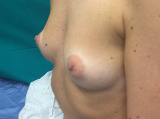 Foto pre Mastoplastica additiva