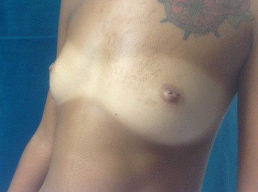 Foto pre Mastoplastica additiva